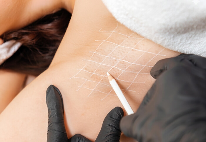 A clinician wearing black gloves marking a grid pattern under a patient’s arm with a white pencil in preparation for a hyperhidrosis treatment.