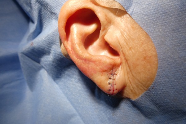 Earlobe repair