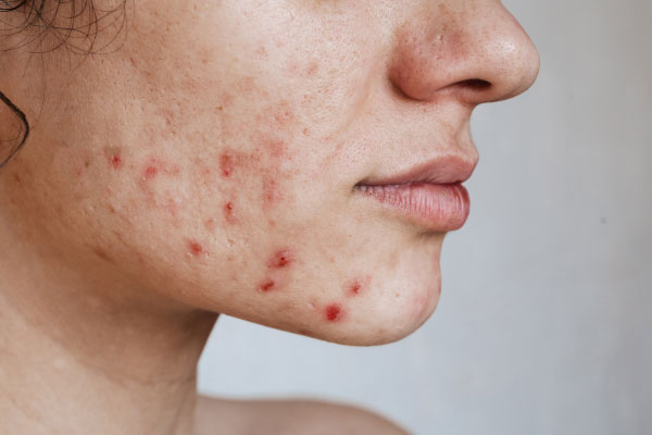 Acne and oily skin