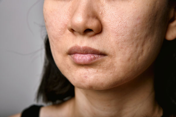 Acne scarring