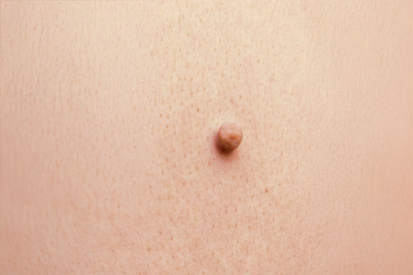 Benign lumps and bumps