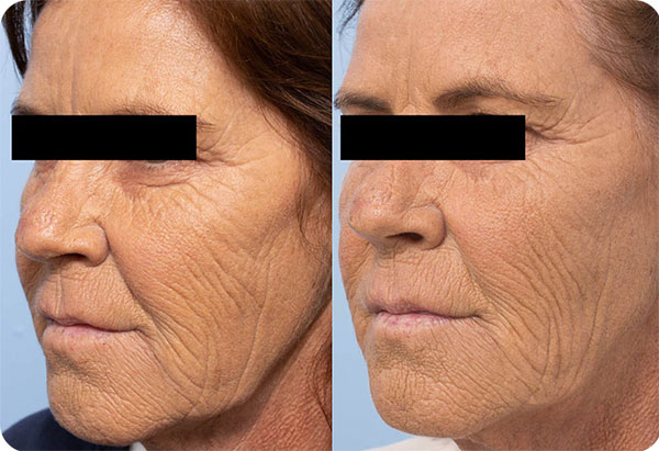 CO2 Laser Treatment_Female