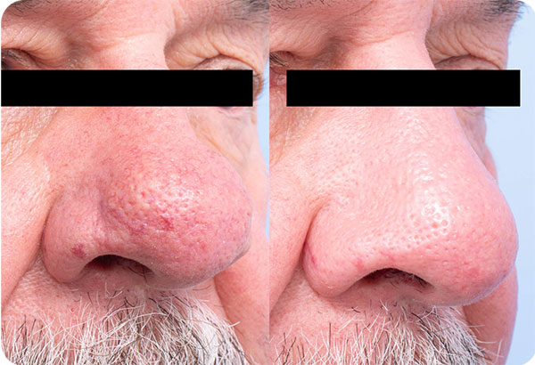 CO2 Laser Treatment Male