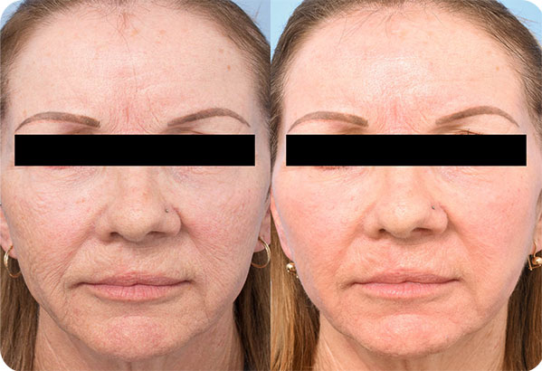 CO2Laser Complete Skin Specialists