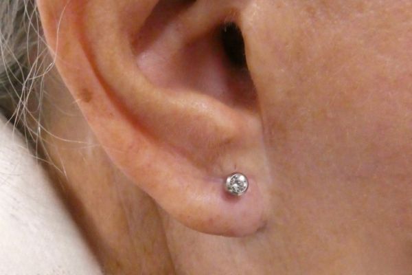 Earlobe repair