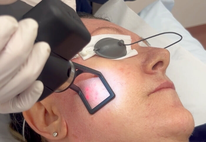 CoolPeel Laser Treatment
