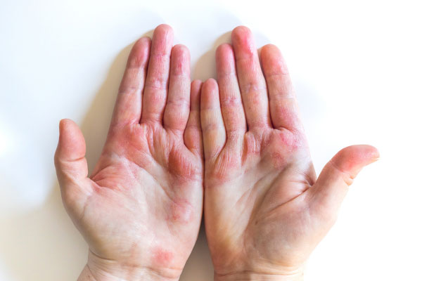 Eczema