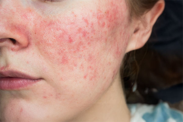 Rosacea