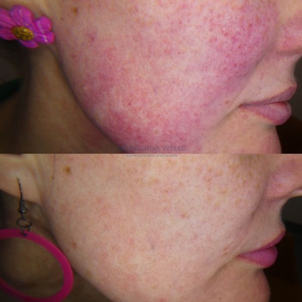 VBeam laser comparison on cheek