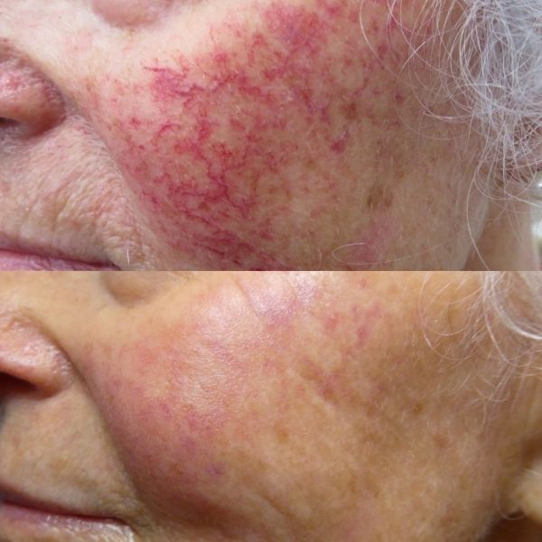 VBeam comparison on cheek