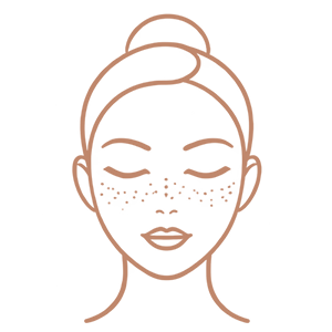 Freckles