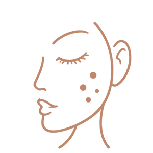 Lentigines