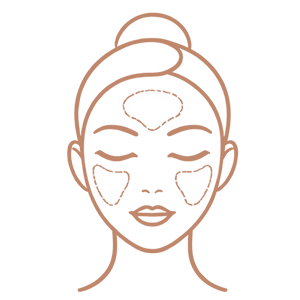Melasma