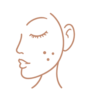 Post-inflammatory pigmentation