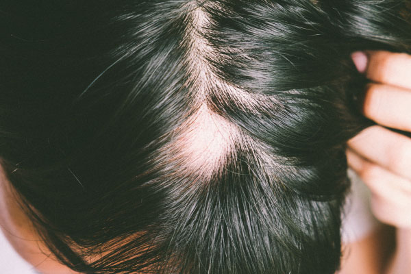 Alopecia