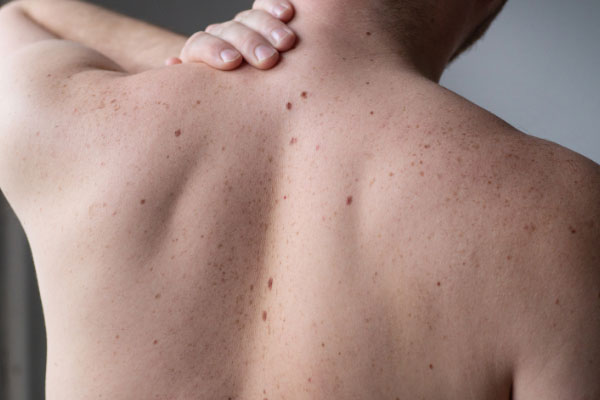 Benign mole and skin lesion removal