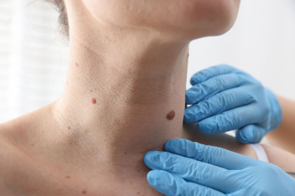 Benign mole