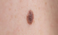 Benign moles​