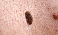Seborrhoeic keratoses