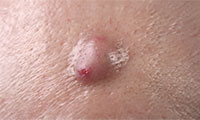 Skin cysts