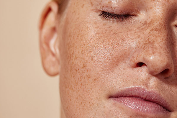Q-Switch laser treatment